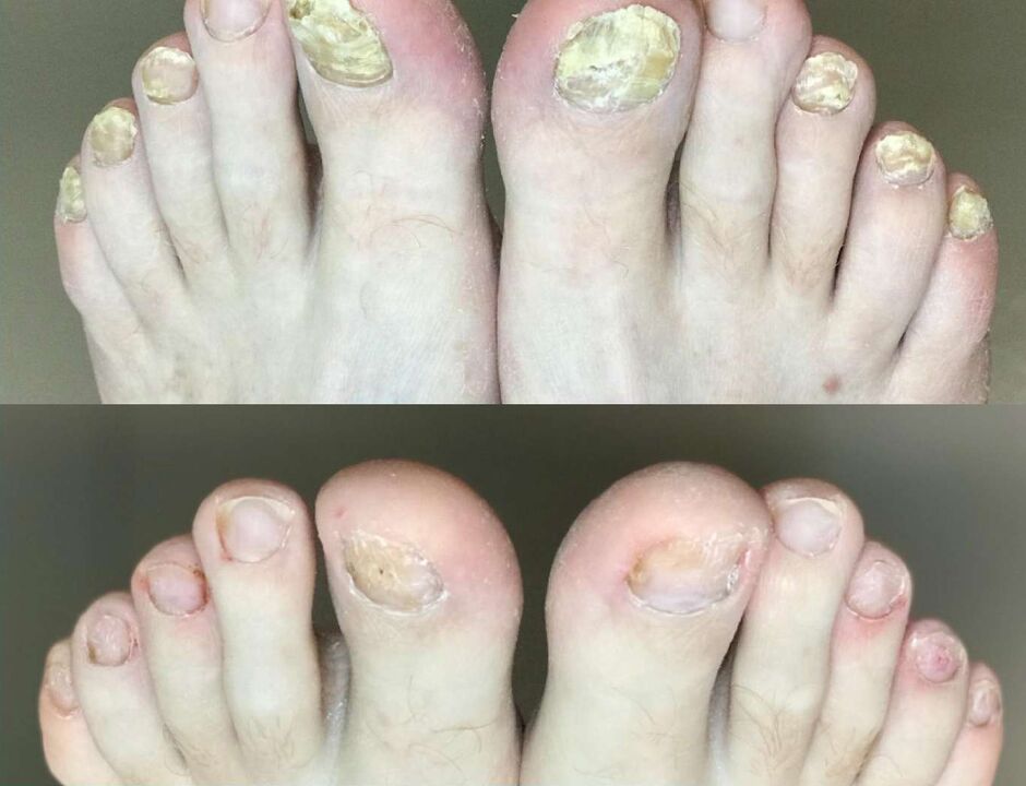 Fungal Promisil Cream before and after treatment
