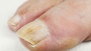 Causes of fungi appearing on the thumb of the leg