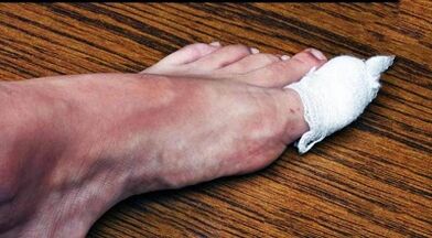 Compress to treat fungi on the thumb