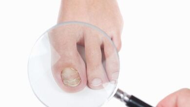 How to treat fungi on the thumb of the leg