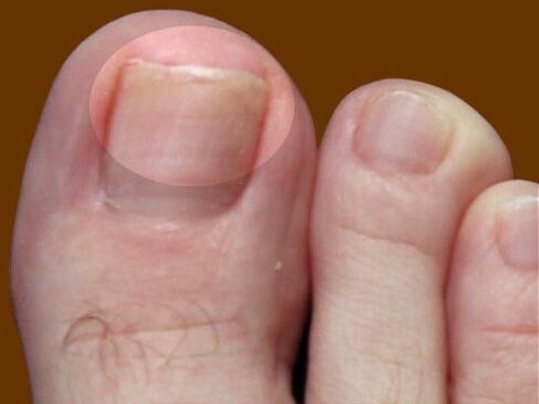 First signs of onychomycosis