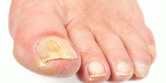 Effective products of nail fungi