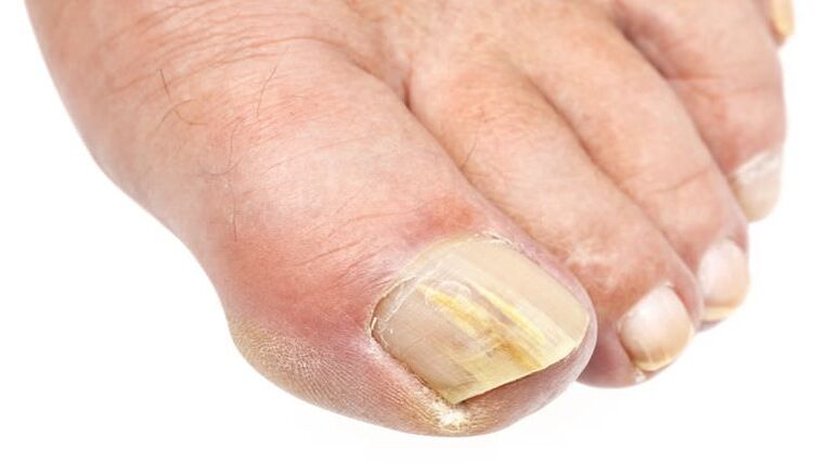 External changes in nails are signs of fungal infection