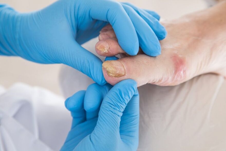 Nail plate affected by fungus