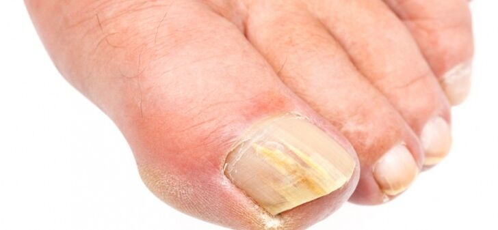 Toenails affected by fungus