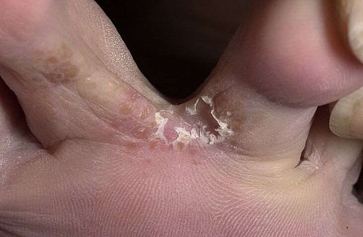 Cracked skin between toes is a symptom of intertriginous fungus