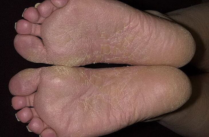 Dry, flaky skin on feet is a sign of scaly fungal disease