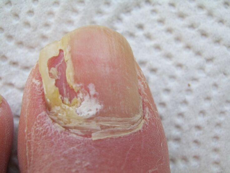 In onychomycosis, the nail plate becomes deformed