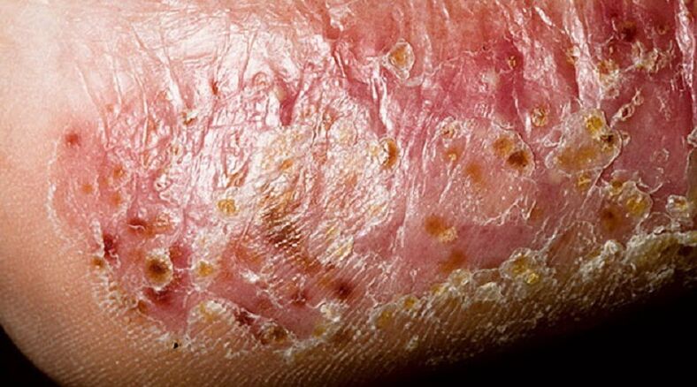 dyshidrotic foot fungus