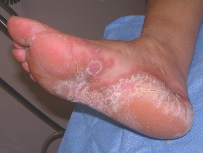 fungal infection of foot