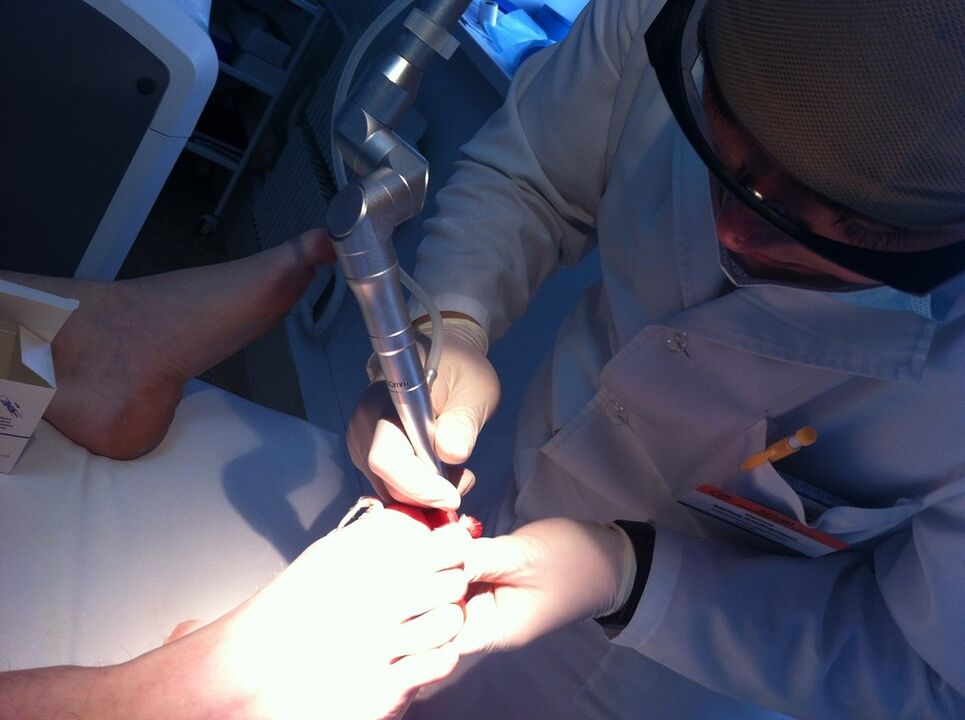 Laser therapy for the outcome