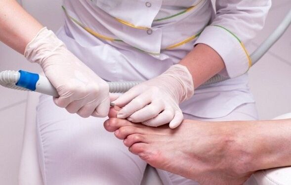 Onychomycosis treatment